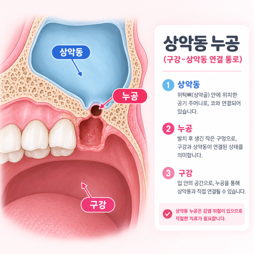 상악동 누공 관련 이미지 2