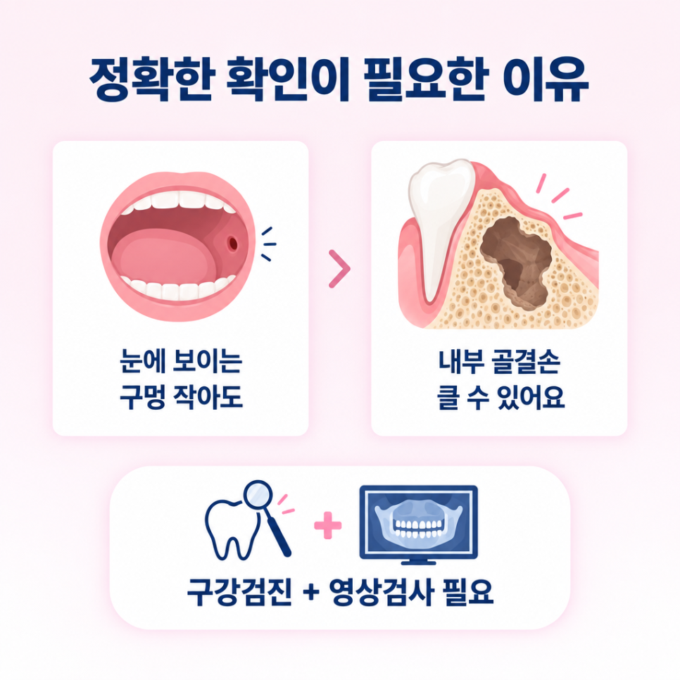 상악동 누공 관련 이미지 12